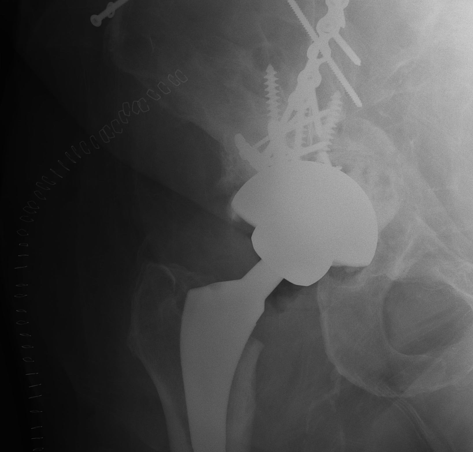 THR Post Acetabular Fracture